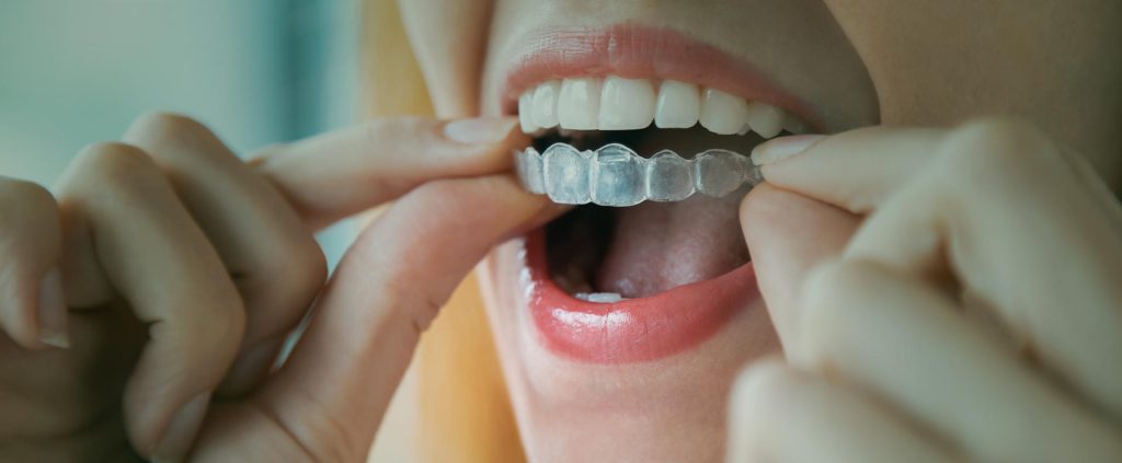 Woman wearing Invisalign brace